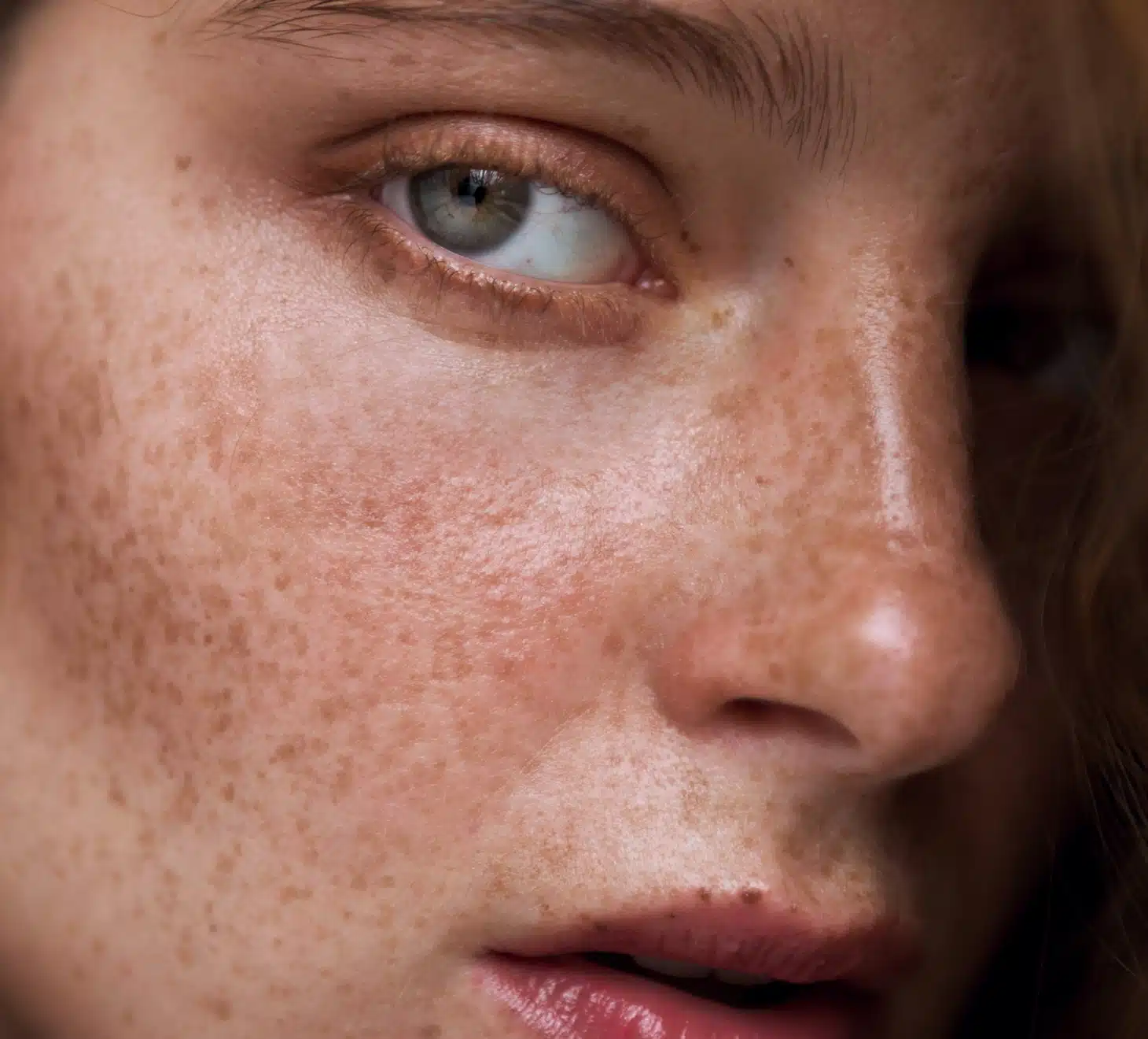 Pointe du nez, chirurgie du nez, visage de femme | Dr Romain Aimard