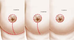 Dessin de sein montrant les trois cicatrices mastopexie lifting mammaire | Dr Aimard Lyon
