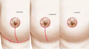 Dessin de sein montrant les trois cicatrices mastopexie lifting mammaire | Dr Aimard Lyon