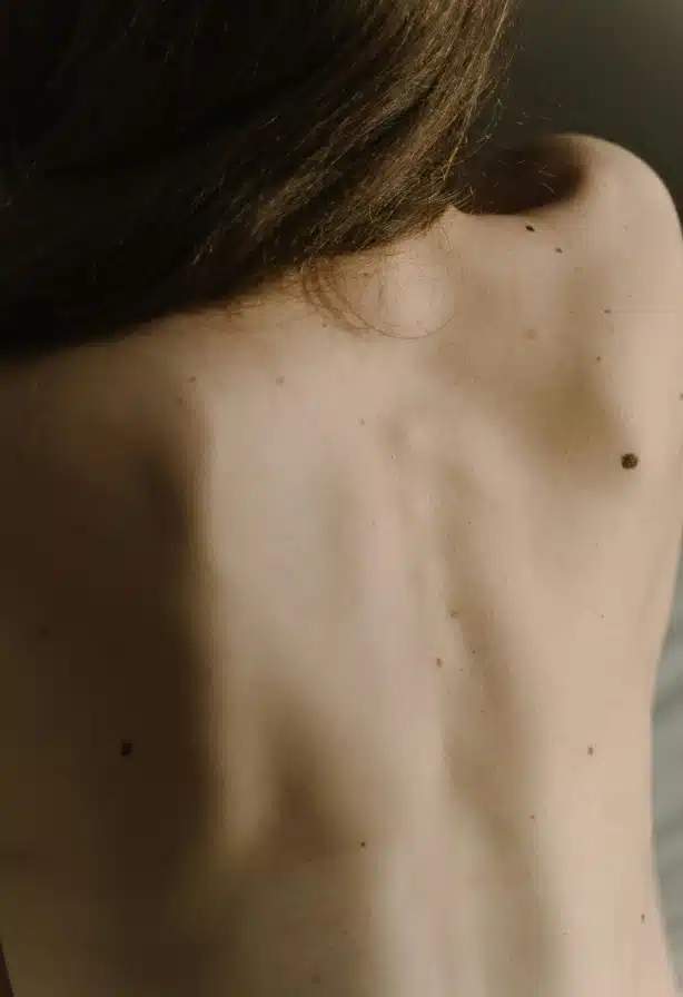 Dos de jeune femme avec grain de beaute chirurgie dermatologue | Dr Aimard Lyon
