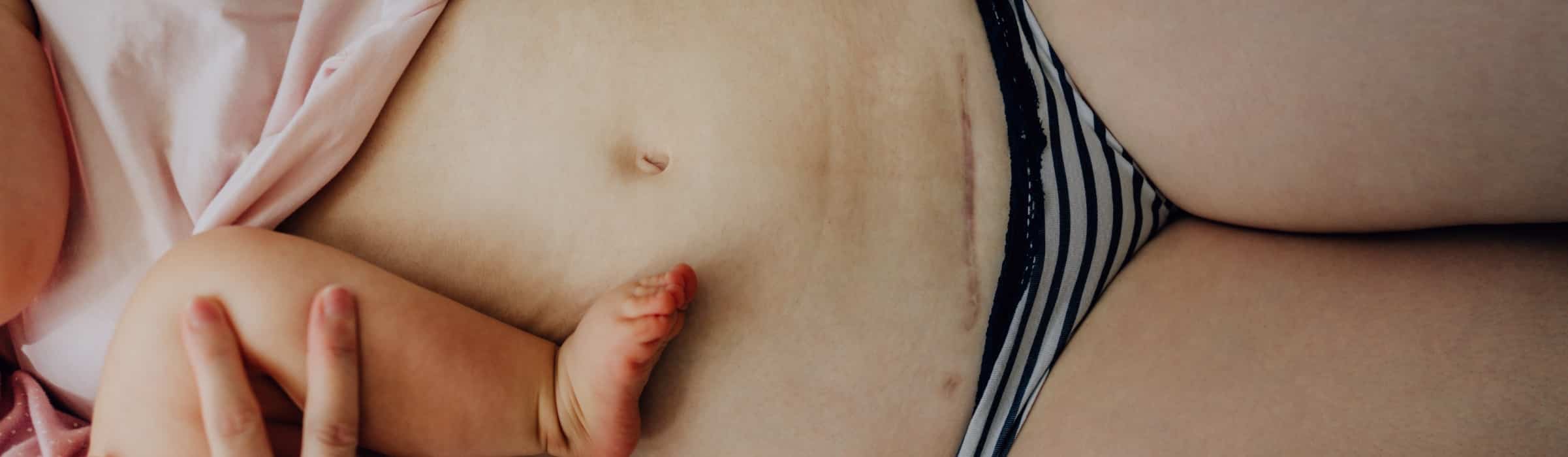 Abdominoplastie post cesarienne
