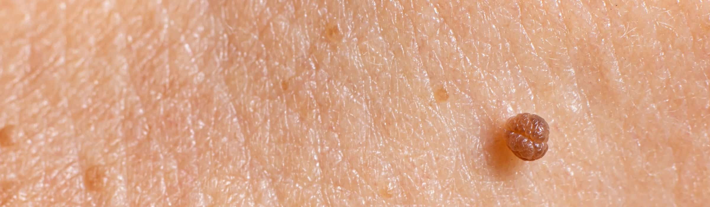 Excroissance cutanées