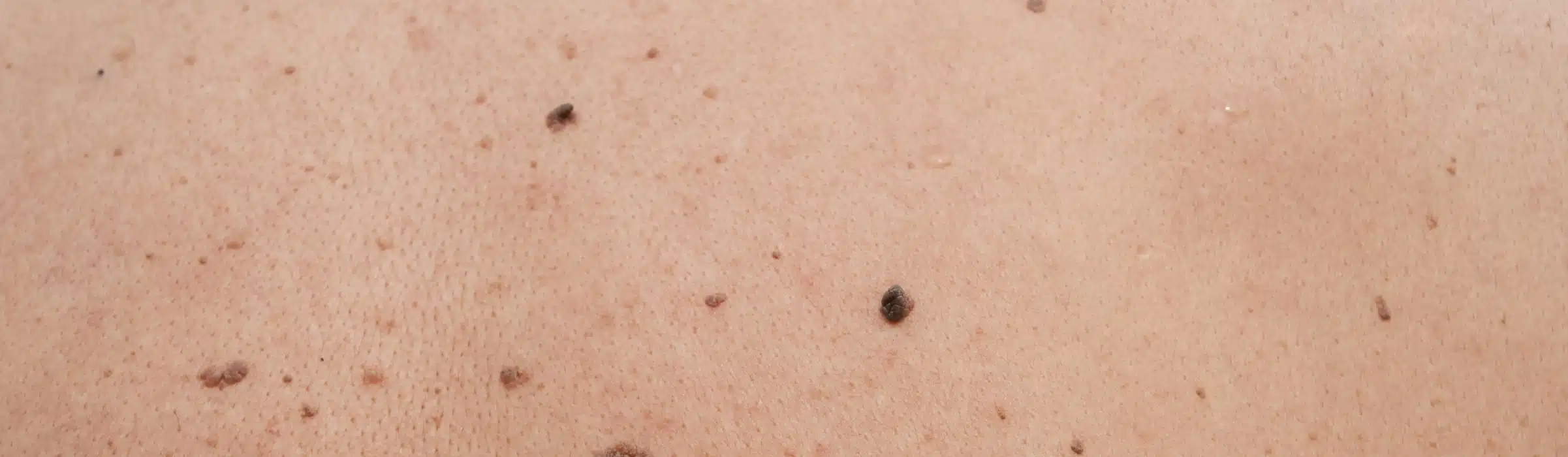 Cancer de la peau