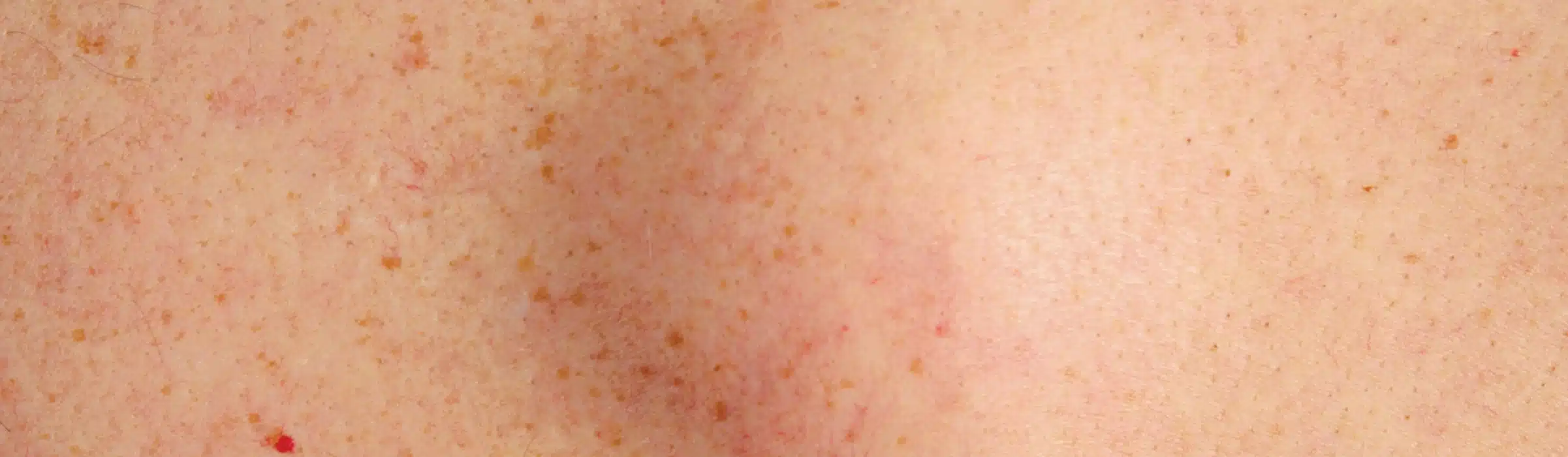lipome vs kyste