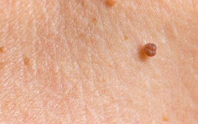 Excroissance cutanées