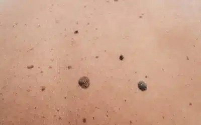 Cancer de la peau