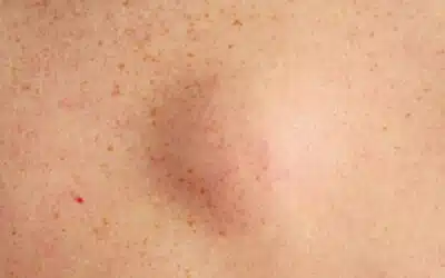lipome vs kyste