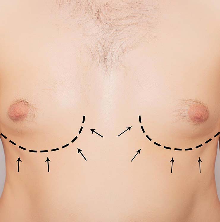 Gynécomastie – Réduction mammaire