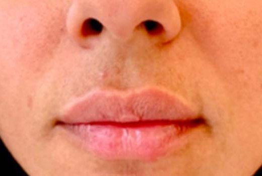Repulper les lèvres avec l’acide hyaluronique à Lyon. Dr Romain AIMARD